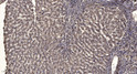 Immunohistochemical analysis of paraffin-embedded human liver cancer. 1, Antibody was diluted at 1:200 (4° overnight). STJ195611