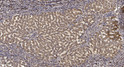 Immunohistochemical analysis of paraffin-embedded human liver cancer. 1, Antibody was diluted at 1:200 (4°C overnight). STJ195622