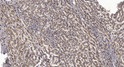 Immunohistochemical analysis of paraffin-embedded human liver cancer. 1, Antibody was diluted at 1:200 (4°C overnight). STJ195626