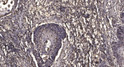 Immunohistochemical analysis of paraffin-embedded human squamous cell carcinoma of lung. 1, Antibody was diluted at STJ195632
