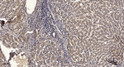 Immunohistochemical analysis of paraffin-embedded human liver cancer. 1, Antibody was diluted at 1:200 (4° overnight). STJ195658