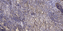 Immunohistochemical analysis of paraffin-embedded human squamous cell carcinoma of lung. 1, Antibody was diluted at STJ195677