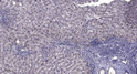 Immunohistochemical analysis of paraffin-embedded human liver cancer. 1, Antibody was diluted at 1:200 (4°C overnight). STJ195683