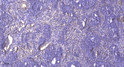 Immunohistochemical analysis of paraffin-embedded human cervical carcinoma. 1, Antibody was diluted at 1:200 (4° STJ195697
