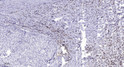 Immunohistochemical analysis of paraffin-embedded human liver cancer. 1, Antibody was diluted at 1:200 (4° overnight). STJ195714