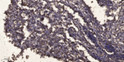Immunohistochemical analysis of paraffin-embedded human squamous cell carcinoma of lung. 1, Antibody was diluted at STJ195727