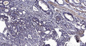 Immunohistochemical analysis of paraffin-embedded human gastric adenocarcinoma. 1, Antibody was diluted at 1:200 (4° STJ195731