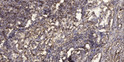 Immunohistochemical analysis of paraffin-embedded human squamous cell carcinoma of lung. 1, Antibody was diluted at STJ195750