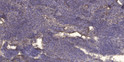 Immunohistochemical analysis of paraffin-embedded human cervical carcinoma. 1, Antibody was diluted at 1:200 (4°C STJ195764