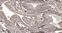 Immunohistochemical analysis of paraffin-embedded human oophoroma. 1, Antibody was diluted at 1:200 (4° overnight). 2, STJ195768