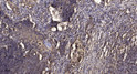 Immunohistochemical analysis of paraffin-embedded human squamous cell carcinoma of lung. 1, Antibody was diluted at STJ195785