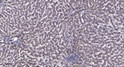 Immunohistochemical analysis of paraffin-embedded human liver cancer. 1, Antibody was diluted at 1:200 (4° overnight). STJ195790