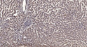 Immunohistochemical analysis of paraffin-embedded human liver cancer. 1, Antibody was diluted at 1:200 (4° overnight). STJ195795