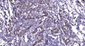 Immunohistochemical analysis of paraffin-embedded human breast cancer. 1, Antibody was diluted at 1:200 (4° overnight). STJ195808