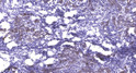 Immunohistochemical analysis of paraffin-embedded human breast cancer. 1, Antibody was diluted at 1:200 (4° overnight). STJ195811