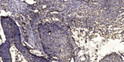 Immunohistochemical analysis of paraffin-embedded human squamous cell carcinoma of lung. 1, Antibody was diluted at STJ195814