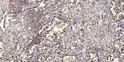 Immunohistochemical analysis of paraffin-embedded human squamous cell carcinoma of lung. 1, Antibody was diluted at STJ195833