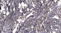 Immunohistochemical analysis of paraffin-embedded human gastric adenocarcinoma. 1, Antibody was diluted at 1:200 (4° STJ195897