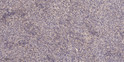 Immunohistochemical analysis of paraffin-embedded human colon cancer. 1, Antibody was diluted at 1:200 (4° overnight). STJ195904