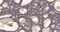 Immunohistochemical analysis of paraffin-embedded human liver cancer. 1, Antibody was diluted at 1:200 (4° overnight). STJ195916