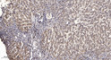 Immunohistochemical analysis of paraffin-embedded human liver cancer. 1, Antibody was diluted at 1:200 (4°C overnight). STJ195931