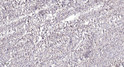 Immunohistochemical analysis of paraffin-embedded human colon cancer. 1, Antibody was diluted at 1:200 (4° overnight). STJ195951