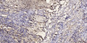 Immunohistochemical analysis of paraffin-embedded human squamous cell carcinoma of lung. 1, Antibody was diluted at STJ195957