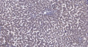 Immunohistochemical analysis of paraffin-embedded human liver cancer. 1, Antibody was diluted at 1:200 (4° overnight). STJ195967