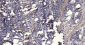 Immunohistochemical analysis of paraffin-embedded human gastric adenocarcinoma. 1, Antibody was diluted at 1:200 (4° STJ195995