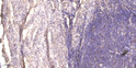 Immunohistochemical analysis of paraffin-embedded human cervical carcinoma. 1, Antibody was diluted at 1:200 (4°C STJ196009