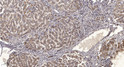 Immunohistochemical analysis of paraffin-embedded human liver cancer. 1, Antibody was diluted at 1:200 (4°C overnight). STJ196010