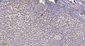 Immunohistochemical analysis of paraffin-embedded human liver cancer. 1, Antibody was diluted at 1:200 (4° overnight). STJ196022