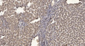 Immunohistochemical analysis of paraffin-embedded human liver cancer. 1, Antibody was diluted at 1:200 (4°C overnight). STJ196032
