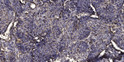 Immunohistochemical analysis of paraffin-embedded human squamous cell carcinoma of the lung. 1, Antibody was diluted at STJ196112