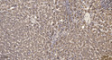 Immunohistochemical analysis of paraffin-embedded human liver cancer. 1, Antibody was diluted at 1:200 (4° overnight). STJ196116