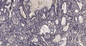 Immunohistochemical analysis of paraffin-embedded human gastric adenocarcinoma. 1, Antibody was diluted at 1:200 (4° STJ196126