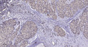 Immunohistochemical analysis of paraffin-embedded human liver cancer. 1, Antibody was diluted at 1:200 (4°C overnight). STJ196127