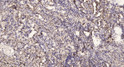 Immunohistochemical analysis of paraffin-embedded human lung cancer. 1, Antibody was diluted at 1:200 (4°C overnight). 2, Tris-EDTA, pH9.0 was used for antigen retrieval. 3, Secondary antibody was diluted at 1:200 (room temperature, 45min). Immunohistochemical analysis of paraffin-embedded human lung cancer. 1, Antibody was diluted at 1:200 (4°C overnight). 2, Tris-EDTA, pH9.0 was used for antigen retrieval. 3, Secondary antibody was diluted at 1:200 (room temperature, 45min).