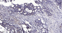 Immunohistochemical analysis of paraffin-embedded human Gastric adenocarcinoma. 1, Antibody was diluted at 1:200 (4°C overnight). 2, Tris-EDTA, pH9.0 was used for antigen retrieval. 3, Secondary antibody was diluted at 1:200 (room temperature, 45min). Immunohistochemical analysis of paraffin-embedded human Gastric adenocarcinoma. 1, Antibody was diluted at 1:200 (4°C overnight). 2, Tris-EDTA, pH9.0 was used for antigen retrieval. 3, Secondary antibody was diluted at 1:200 (room temperature, 45min).