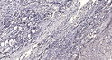 Immunohistochemical analysis of paraffin-embedded human Gastric adenocarcinoma. 1, Antibody was diluted at 1:200 (4°C overnight). 2, Tris-EDTA, pH9.0 was used for antigen retrieval. 3, Secondary antibody was diluted at 1:200 (room temperature, 45min).