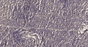 Immunohistochemical analysis of paraffin-embedded human meningioma. 1, Antibody was diluted at 1:200 (4°C overnight). 2, Tris-EDTA, pH9.0 was used for antigen retrieval. 3, Secondary antibody was diluted at 1:200 (room temperature, 45min).