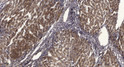 Immunohistochemical analysis of paraffin-embedded human liver cancer. 1, Antibody was diluted at 1:200 (4°C overnight). 2, Tris-EDTA, pH9.0 was used for antigen retrieval. 3, Secondary antibody was diluted at 1:200 (room temperature, 45min).