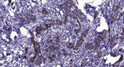 Immunohistochemical analysis of paraffin-embedded human Breast cancer. 1, Antibody was diluted at 1:200 (4°C overnight). 2, Tris-EDTA, pH9.0 was used for antigen retrieval. 3, Secondary antibody was diluted at 1:200 (room temperature, 45min). Immunohistochemical analysis of paraffin-embedded human Breast cancer. 1, Antibody was diluted at 1:200 (4°C overnight). 2, Tris-EDTA, pH9.0 was used for antigen retrieval. 3, Secondary antibody was diluted at 1:200 (room temperature, 45min).