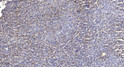 Immunohistochemical analysis of paraffin-embedded human liver cancer. 1, Antibody was diluted at 1:200 (4°C overnight). 2, Tris-EDTA, pH9.0 was used for antigen retrieval. 3, Secondary antibody was diluted at 1:200 (room temperature, 45min).