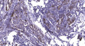 Immunohistochemical analysis of paraffin-embedded human Breast cancer. 1, Antibody was diluted at 1:200 (4°C overnight). 2, Tris-EDTA, pH9.0 was used for antigen retrieval. 3, Secondary antibody was diluted at 1:200 (room temperature, 45min).