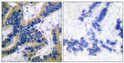 Immunohistochemistry analysis of paraffin-embedded human lung carcinoma tissue, using Caspase 6 (Cleaved-Asp162) Antibody. The picture on the right is blocked with the synthesized peptide.