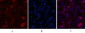 Immunofluorescence analysis of Human-breast-cancer tissue. 1, Caspase-7 Polyclonal Antibody (red) was diluted at 1:200 (4°C, overnight). 2, Cy3 labled Secondary antibody was diluted at 1:300 (room temperature, 50min).3, Picture B: DAPI (blue) 10min. Picture A:Target. Picture B: DAPI. Picture C: merge of A+B