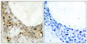 Immunohistochemistry analysis of paraffin-embedded human breast carcinoma, using BCL-2 (Phospho-Ser70) Antibody. The picture on the right is blocked with the phospho peptide.