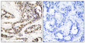 Immunohistochemistry analysis of paraffin-embedded human breast carcinoma, using CREB (Phospho-Ser129) Antibody. The picture on the right is blocked with the phospho peptide.