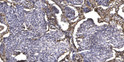 Immunohistochemical analysis of paraffin-embedded human squamous cell carcinoma of lung. 1, Antibody was diluted at STJ90322